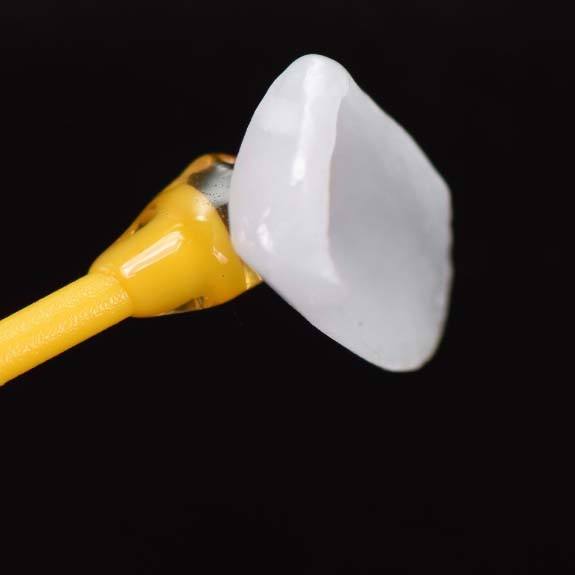 dental veneer